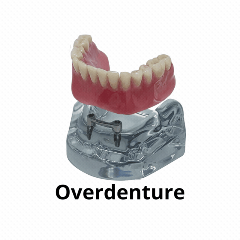 Sistemas de retenção para overdenture: O-ring, Locator e Barra-Clipe
